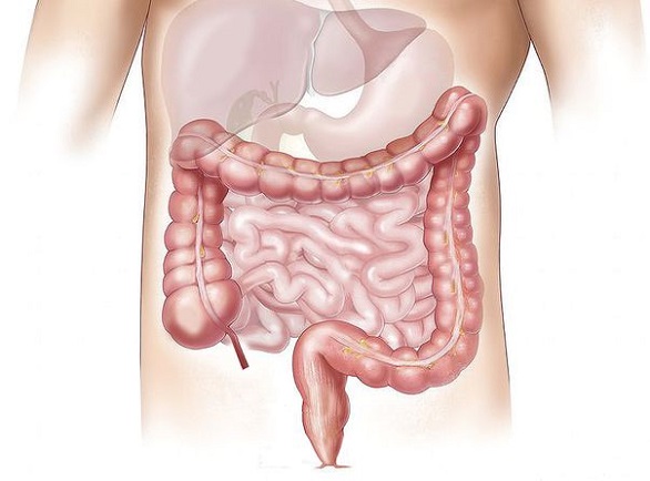 Cancerul de colon are simptome înșelătoare