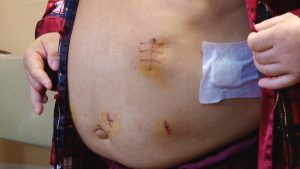 OPERATIE ESOFAG LA SPITALUL JUDETEAN.Still008