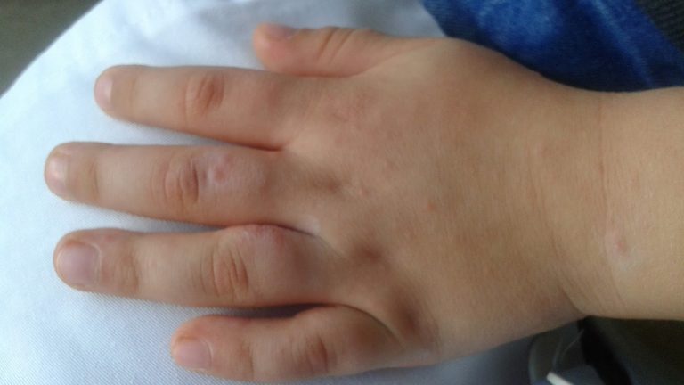 Boala mâinilor murdare face ravagii lângă Timișoara. Peste 20 de copii, infestați
