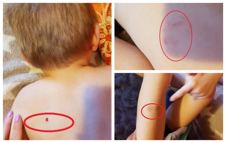 Părinți disperați în Timiș. Și-au luat copilul de la grădiniță cu urme de mușcături și vânătăi pe corp