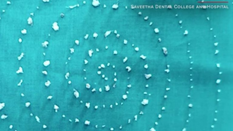 Caz medical rar: Unui copil i-au crescut 526 de „dinți”