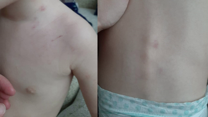 Copil de un an şi nouă luni, agresat din prima zi de creșă. Ce au descoperit părinții pe trupul micuțului