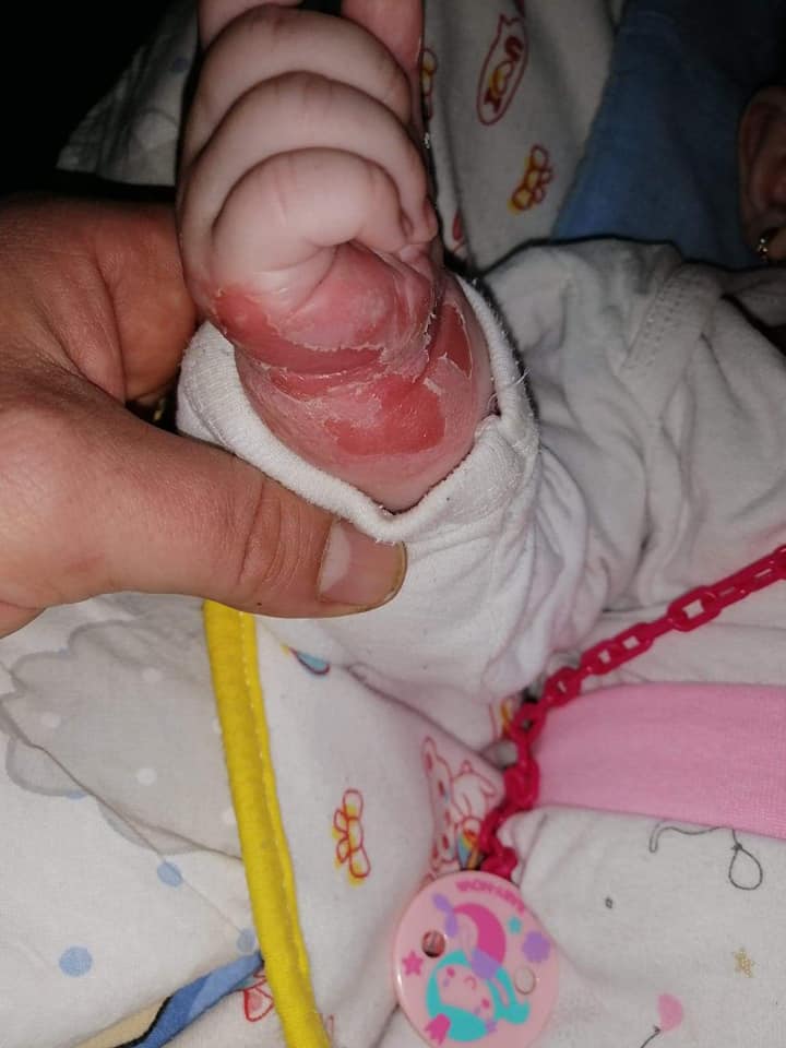 Fetiță de 5 luni cu alergie severă după ce nu i-ar fi fost schimbat bandajul de la branulă timp de o săptămână