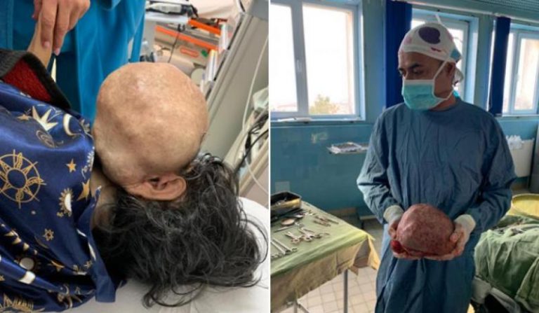 Tumoră gigant, extirpată într-un spital din vestul țării