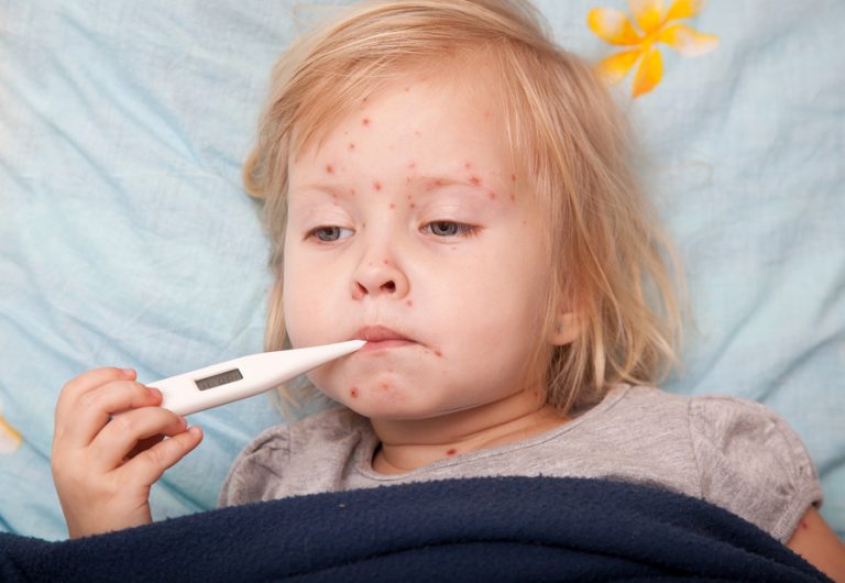 Medicii avertizează: au explodat cazurile de varicelă în Timiș