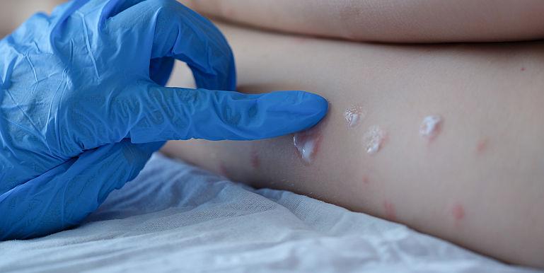 Al treilea caz de variola maimuței în România