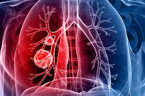Medicii de la Spitalul ,,Victor Babeș” pot stabili cu exactitate diagnosticul în oncologia pulmonară